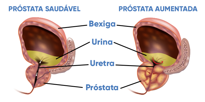 Prostata aumentada o que e HPB